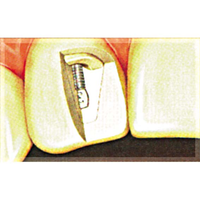 Op Po Precious Posts Blue 1.75mm 10/pk Pack